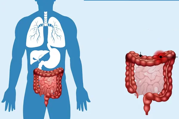 IBS Treatment