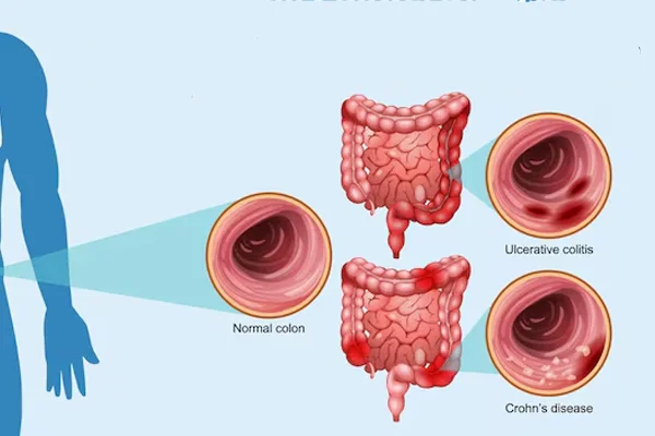 IBD Specialist in Gurugram